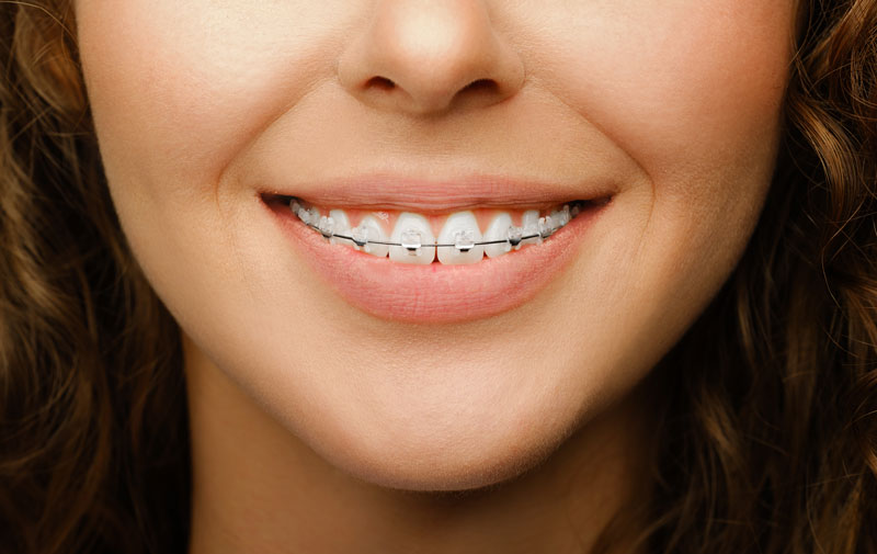 Cuánto dura la ortodoncia para adolescentes con brackets de zafiro