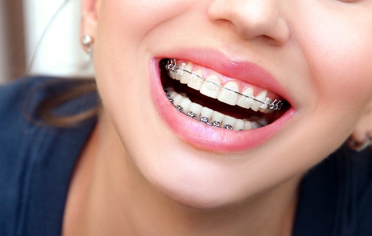 La importancia de la estética en la ortodoncia para adolescentes