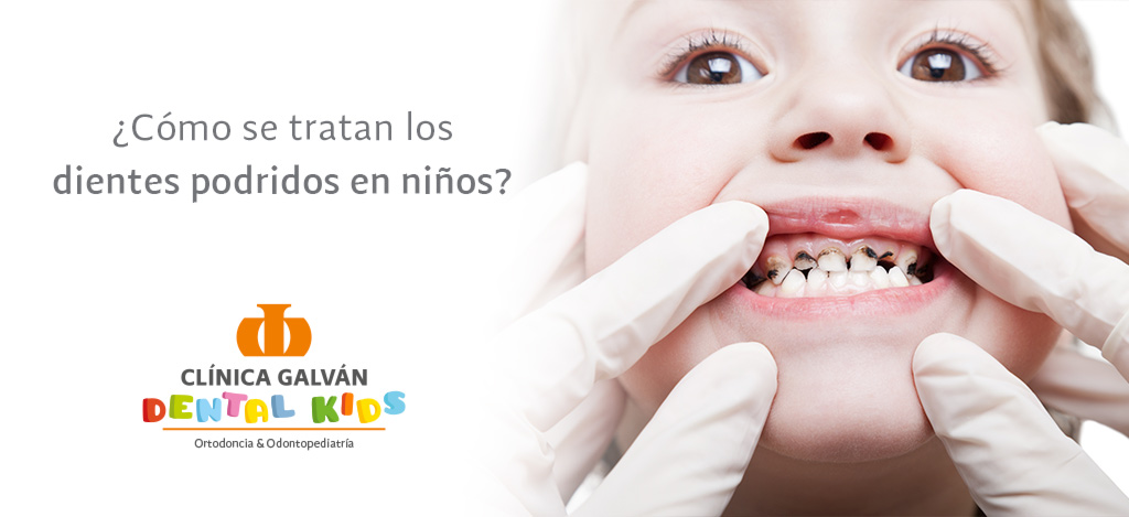 Niños con dientes podridos: ¿cómo tratarlos?